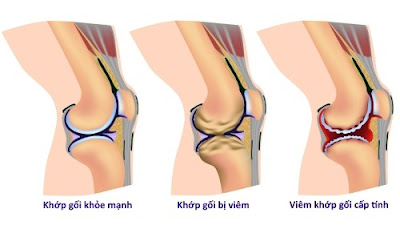 Tìm hiểu viêm khớp cấp tính là bệnh gì ?