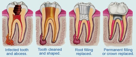 Root Canal Treatment India