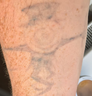 Black ink tattoo fading from picosure laser