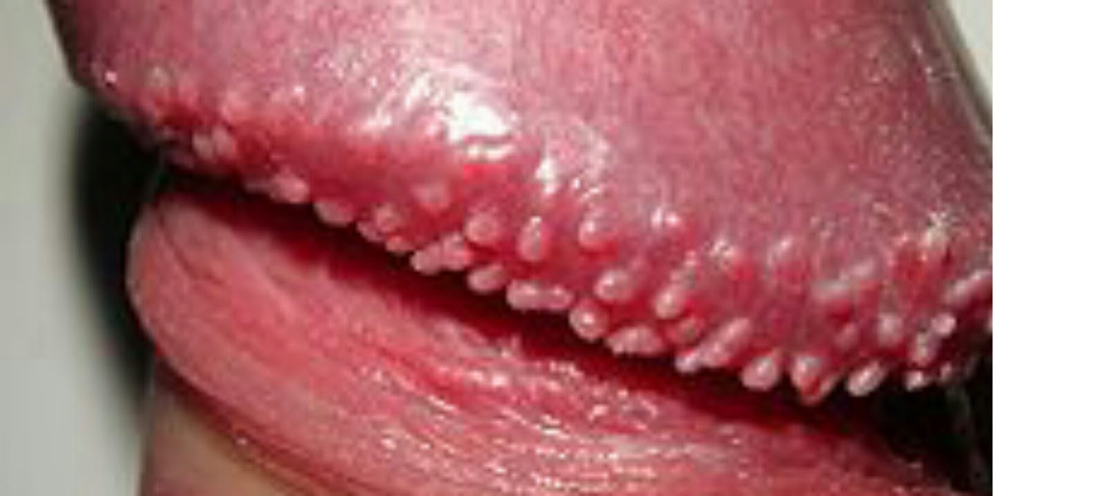 Cara Mengobati Virus Hpv