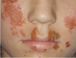 pityrosporum folliculitis causes