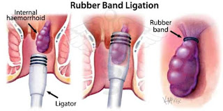 Rubber band ligation in hemorrhoids