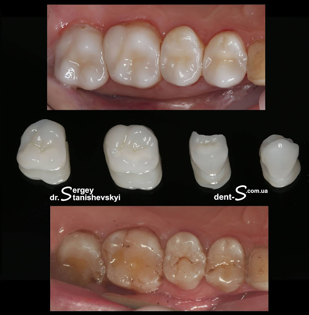 стоматолог стоматология Виниры Киев Станишевский Сергей накладки коронки керамика керамическая реставрации вкладки e-max inlay onlay overlay veneer veneers