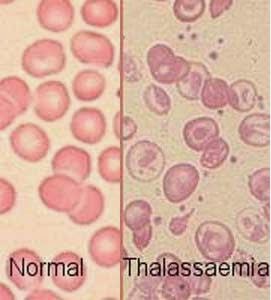 Indonesia Jadi Negara Lempengan Sabuk Penyakit Thalasemia