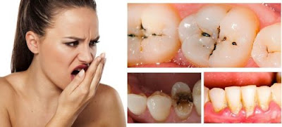 Lý giải tại sao sâu răng lại hôi miệng 2