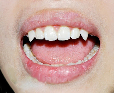 Mài răng nanh nhọn cải thiện thẩm mỹ 1