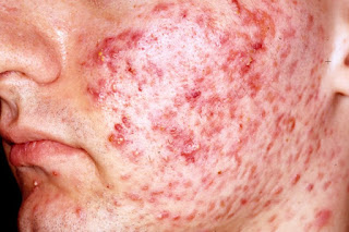 Picture of acne vulgaris
