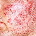 How To Avoid Acne Vulgaris  - All About Acne