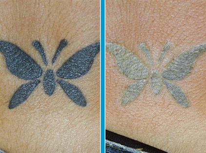 Laser tattoo removal is by far the most effective tattoo removal method to