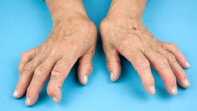 Symptoms The Most cause Treatment For Rheumatoid 