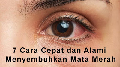 7 Cara Cepat dan Alami Menyembuhkan Mata Merah