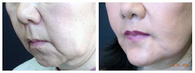 Chin Surgery