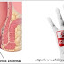 obat herbal wasir yang ampuh thumbnail