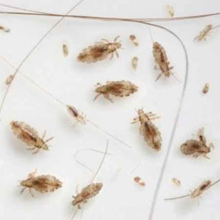 Picture Of Lice In Hair