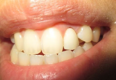 Easy yet affordable teeth implants in Dublin