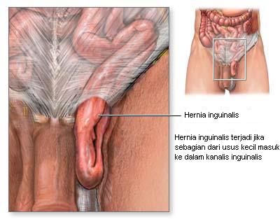 hernia