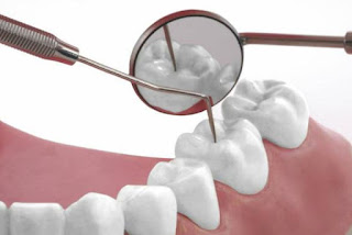 Trám răng lấy tủy có đau không-3