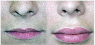 Lip Augmentation Before And After