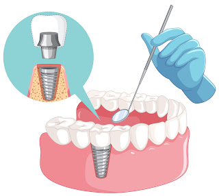 dental implants in gurgaon