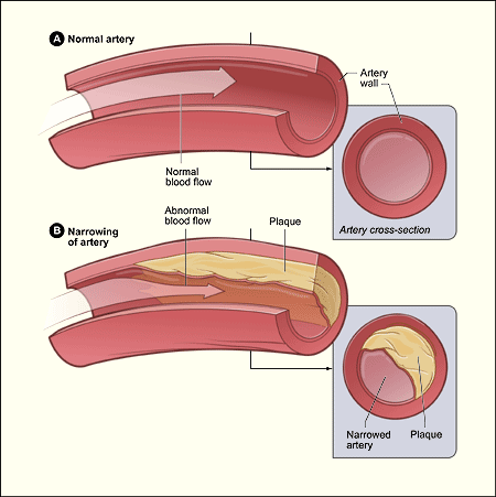 heart attack diagram. heart attack diagram