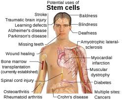 Stem cell therapy use, meaning of Stem cell therapy