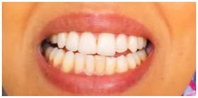 Dientes Amarillos, ¿Como Quitarlos y Porque los Tengo? CONSEJOS PRÁCTICOS!