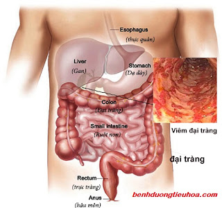 đại tràng mh là gì