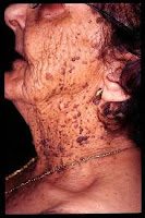 queratosis seborreica