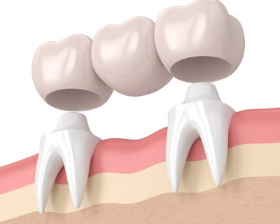 Trồng răng khi còn chân răng có được không