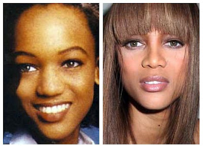 Tyra Banks Plastic Surgery