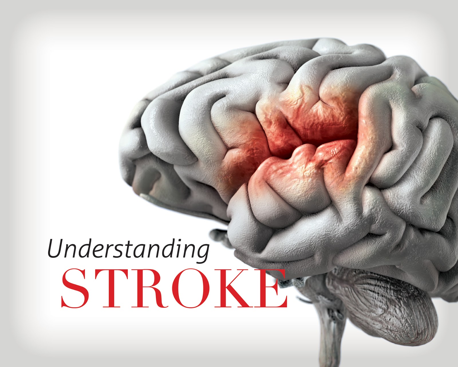 Obat stroke, obat herbal stroke, obat menyembuhkan stroke, obat menangani stroke, obat untuk stroke, obat alami stroke