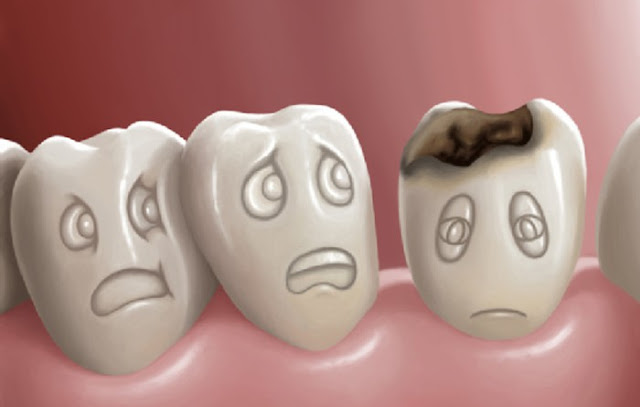 Răng sâu không thể giữ lại chân răng thì nhổ bỏ là cách tốt nhất