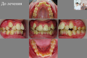 Прикус пациента, показания для удаления зубов