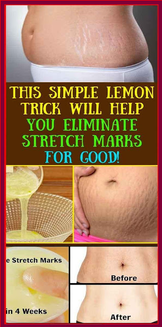 This Simple Lemon Trick Will Help You Eliminate Stretch Marks For Good