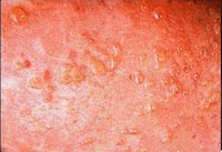 dermatitis herpetiformis pictures, symptoms, and treatment