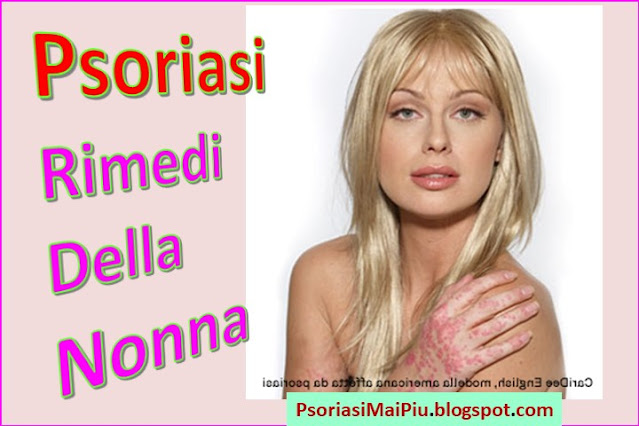 psoriasi-rimedi-della-nonna-naturali-casalinghi-curare