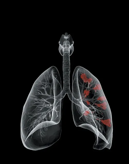 Mesothelioma Survival Rates & Life Expectancy