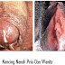 Kencing nanah pada pria