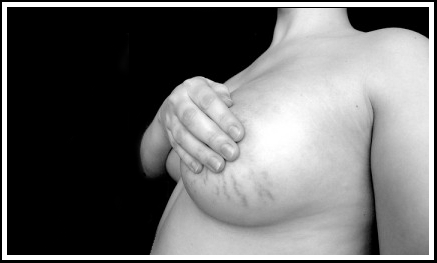 Stretch Marks on Breasts1