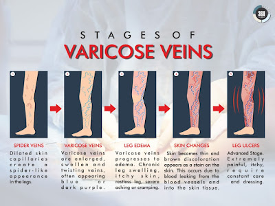 venous laser treatment