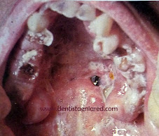 <Imgsrc ="Estomatitis-necrosante-en-SIDA.jpg" width = "274" height "140" border = "0" alt = "Estomatitis necrosante y VIH">