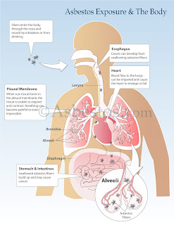 Mesothelioma