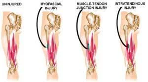 What is a Musculotendinous injury?