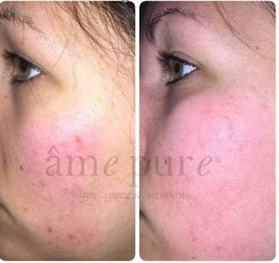 Mezo roller before and after treatment (pictures)