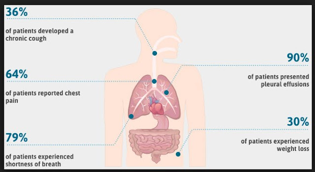 Mesothelioma Stages Number One Question You Must Ask for Pleural