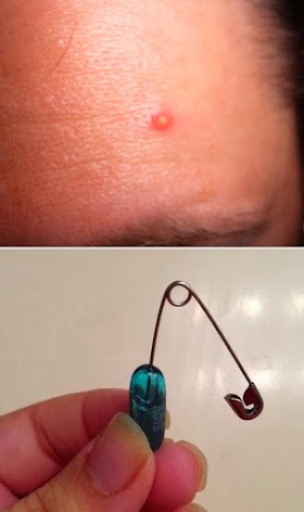 For those inflamed, painful pimples that just show up out of nowhere. Bust Open An Advil Liquid Gel And Put The Gel On the Pimple. it relieves pain and redness almost instantly.