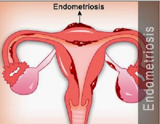 Terapi Non farmakologi Endometriosis