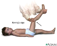 kernig sign, tanda kernig sign, pemeriksaan kernig sign, cara kernig sign, melakukan kernig sign