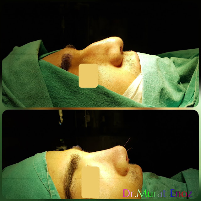 Male thick skinned rhinoplasty, Nose job for men Istanbul Turkey