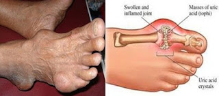 Cra cepat mengobati asam urat, cara mengatasi asam urat pada kaki, penyebab dan cara mencegah penyakit asam urat, cara mengobati kolesterol dan asam urat secara alami, cara penyembuhan total penyakit asam urat, cara menyembuhkan asam urat dengan herbal, penyebab asam urat tinggi dan cara mengatasinya, obat asam urat resep dokter, obat kolesterol dan asam urat, cumi untuk asam urat, www.cara mengatasi penyakit asam urat.com